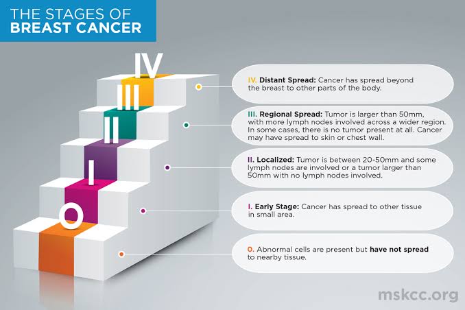 Exploring theStages of Breast Cancer